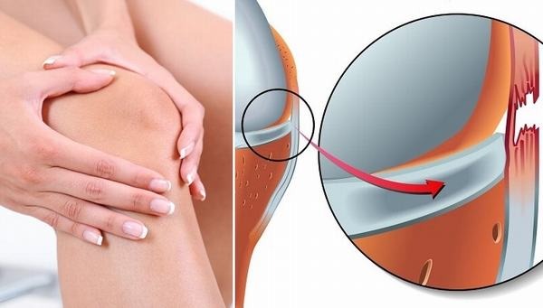 Hiểu rõ về giãn dây chằng để điều trị đúng cách