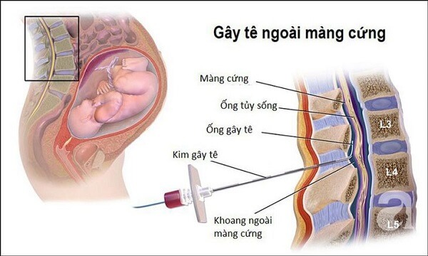 phuong-phap-gay-te-ngoai-mang-cung
