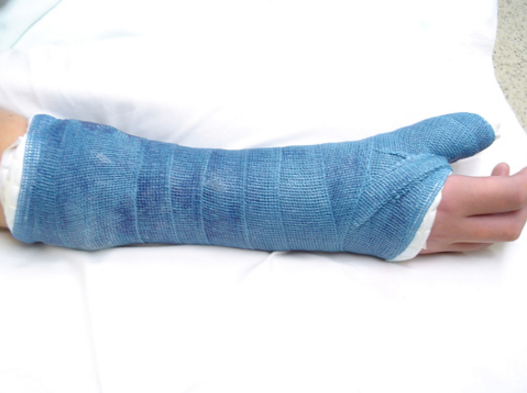 Phục hồi chức năng cho người bị gãy xương